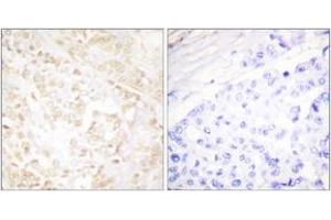 Immunohistochemistry analysis of paraffin-embedded human breast carcinoma tissue, using XRCC6 Antibody. (RCC6 (AA 554-603) Antikörper)