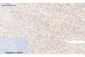 Immunohistochemical analysis of paraffin-embedded human uterus cancer tissue.