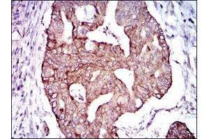 Immunohistochemical analysis of paraffin-embedded rectum cancer tissues using PDE1B mouse mAb with DAB staining. (PDE1B Antikörper  (AA 370-536))