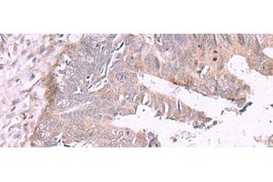 Immunohistochemistry of paraffin-embedded Human colorectal cancer tissue using ZSWIM1 Polyclonal Antibody at dilution of 1:55(x200) (ZSWIM1 Antikörper)