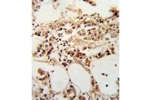 Formalin-fixed and paraffin-embedded human breast carcinoma reacted with TI Antibody (Center), which was peroxidase-conjugated to the secondary antibody, followed by DAB staining. (TIMP3 Antikörper  (AA 113-139))