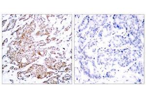 Immunohistochemical analysis of paraffin-embedded human breast carcinoma tissue using Myc (phospho-Thr58) antibody (E011034). (c-MYC Antikörper  (pThr58))