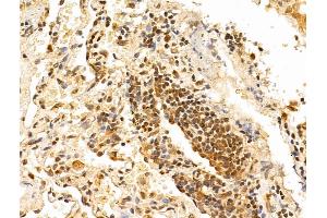 ABIN6265436 and ABIN6273019 at 1/100 staining Human lung cancer by IHC-P.