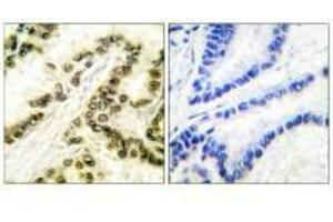 Immunohistochemical analysis of paraffin-embedded human breast carcinoma tissue using AP-2 antibody. (TFAP2A Antikörper)