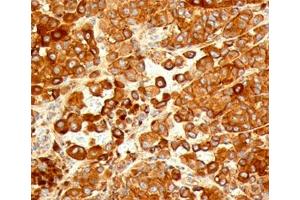 IHC testing of human melanoma stained with CD63 antibody (NKI/C3). (CD63 Antikörper)