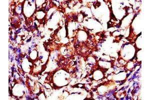 Immunohistochemistry of paraffin-embedded human gastric cancer using ABIN7146178 at dilution of 1:100 (ZMPSTE24 Antikörper  (AA 217-347))