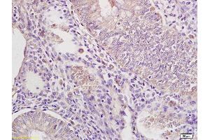 Formalin-fixed and paraffin embedded human endometrium carcinoma labeled with Rabbit Anti IRAK4 Polyclonal Antibody, Unconjugated (ABIN740310) at 1:200 followed by conjugation to the secondary antibody and DAB staining (IRAK4 Antikörper  (AA 21-120))