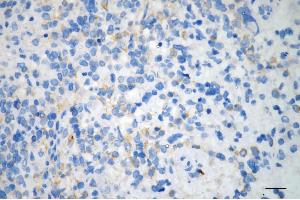 Immunohistochemistry was performed on paraffin-embedded human glioblastoma using CDC42BPA antibody (ABIN7797991), 1:200). (CDC42BPA Antikörper)