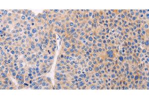 Immunohistochemistry of paraffin-embedded Human liver cancer using ADCY1 Polyclonal Antibody at dilution of 1:60 (ADCY1 Antikörper)