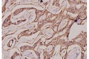 Immunohistochemical analysis of paraffin-embedded human breast cancer tissue using IgG1 polyclonal antibody . (Kaninchen anti-Human IgG1 (AA 211-260) Antikörper)