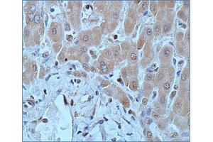 Immunohistochemical staining (Formalin-fixed paraffin-embedded sections) of human hepatocellular carcinoma with DNMT1 monoclonal antibody, clone 60B1220. (DNMT1 Antikörper  (AA 637-650))