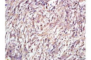 Formalin-fixed and paraffin embedded human laryngeal tissue labeled with Rabbit Anti-ENT2 Polyclonal Antibody, Unconjugated (ABIN2559658) at 1:200 followed by conjugation to the secondary antibody and DAB staining (SLC29A2 Antikörper  (AA 221-320))
