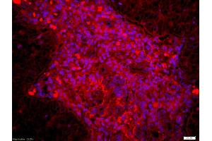 Formalin-fixed and paraffin embedded human laryngocarcinoma labeled with Anti Dyrk1B Polyclonal Antibody, Unconjugated (ABIN716501) at 1:200 followed by conjugation to the secondary antibody Goat Anti-Rabbit IgG, Cy3 conjugated used at 1:200 dilution for 40 minutes at 37°C and DAPI staining (DYRK1B Antikörper  (AA 35-130))