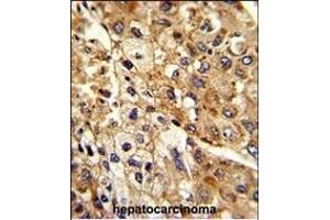 Formalin-fixed and paraffin-embedded human hepatocarcinoma reacted with ATP1B2 Antibody (Center), which was peroxidase-conjugated to the secondary antibody, followed by DAB staining. (ATP1B2 Antikörper  (AA 115-141))