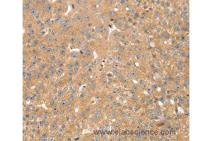 Immunohistochemistry of Human breast cancer using SNX2 Polyclonal Antibody at dilution of 1:40 (Sorting Nexin 2 Antikörper)