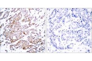 Immunohistochemistry analysis of paraffin-embedded human breast carcinoma, using Myc (Phospho-Thr58) Antibody. (c-MYC Antikörper  (pThr58))