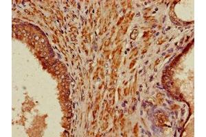 Immunohistochemistry of paraffin-embedded human prostate cancer using ABIN7165984 at dilution of 1:100 (PIH1D3 Antikörper  (AA 1-214))