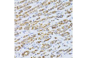 Immunohistochemistry of paraffin-embedded human colon carcinoma using CCDC92 antibody (ABIN5974817) at dilution of 1/100 (40x lens). (CCDC92 Antikörper)