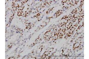 Immunoperoxidase of monoclonal antibody to MCM7 on formalin-fixed paraffin-embedded human ovary, clear cell carcinoma.