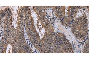 Immunohistochemistry of paraffin-embedded Human colon cancer using CUL3 Polyclonal Antibody at dilution of 1:30 (Cullin 3 Antikörper)