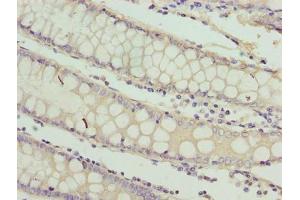 Immunohistochemistry of paraffin-embedded human colon cancer using ABIN7167326 at dilution of 1:100 (RAB3B Antikörper  (AA 1-219))