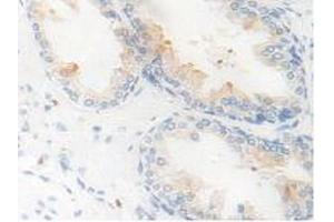 IHC-P analysis of Human Prostate Gland Tissue, with DAB staining. (Kallikrein 11 Antikörper  (AA 39-282))