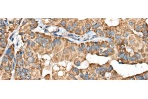 Immunohistochemistry of paraffin-embedded Human thyroid cancer tissue using BLNK Polyclonal Antibody at dilution of 1:40(x200) (B-Cell Linker Antikörper)