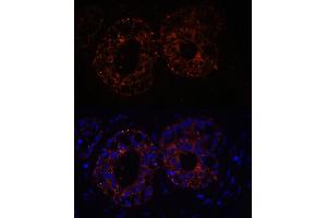 Immunofluorescence analysis of Human mammary cancer cells using TNF-α antibody (ABIN3020862, ABIN3020863, ABIN3020864, ABIN1513617 and ABIN6213762) at dilution of 1:100. (TNF alpha Antikörper  (AA 1-233))