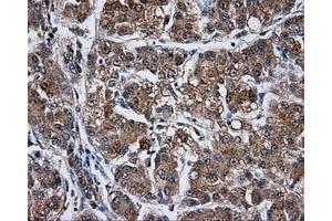 Immunohistochemical staining of paraffin-embedded Carcinoma of liver tissue using anti-KIAA1609 mouse monoclonal antibody. (KIAA1609 Antikörper)
