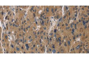 Immunohistochemistry of paraffin-embedded Human liver cancer using RAGE Polyclonal Antibody at dilution of 1:70 (RAGE Antikörper)