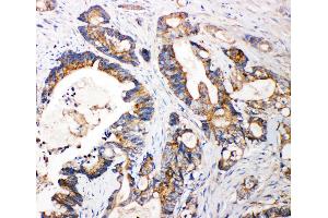 Anti-FGFR3 antibody, IHC(P) IHC(P): Human Intestinal Cancer Tissue (FGFR3 Antikörper  (N-Term))