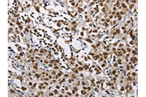 The image on the left is immunohistochemistry of paraffin-embedded Human esophagus cancer tissue using ABIN7128978(CMTM2 Antibody) at dilution 1/60, on the right is treated with fusion protein.