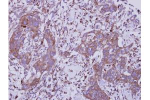 IHC-P Image Immunohistochemical analysis of paraffin-embedded human breast cancer, using TLR5, antibody at 1:250 dilution. (TLR5 Antikörper  (N-Term))