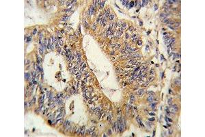 IHC analysis of FFPE human colon carcinoma stained with IL17RB antibody (IL17 Receptor B Antikörper  (AA 207-234))