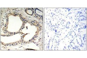 Immunohistochemical analysis of paraffin-embedded human breast carcinoma tissue using IkB-e(Phospho-Ser22) Antibody(left) or the same antibody preincubated with blocking peptide(right). (NFKBIE Antikörper  (pSer22))