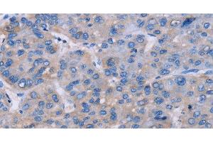 Immunohistochemistry of paraffin-embedded Human liver cancer tissue using NR1D1 Polyclonal Antibody at dilution 1:60 (NR1D1 Antikörper)