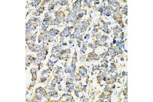 Immunohistochemistry of paraffin-embedded human lung cancer using ADSS antibody (ABIN6131467, ABIN6136604, ABIN6136606 and ABIN6216015) at dilution of 1:100 (40x lens). (ADSS Antikörper  (AA 1-280))