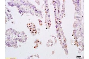 Formalin-fixed and paraffin embedded human breast carcinoma labeled with Anti-phospho-STAT3 (Tyr705) Polyclonal Antibody, Unconjugated (ABIN732638) at 1:200 followed by conjugation to the secondary antibody and DAB staining. (STAT3 Antikörper  (pTyr705))