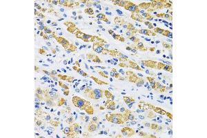 Immunohistochemistry of paraffin-embedded human liver cancer using SLC16A4 antibody. (SLC16A4 Antikörper)