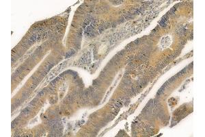 ABIN6261832 and ABIN6276853 at 1/100 staining human colon carcinoma by IHC-P.