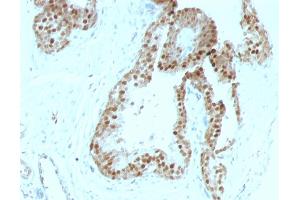 Formalin-fixed, paraffin-embedded human Prostate Carcinoma stained with p57 Mouse Monoclonal Antibody (KIP2/880). (CDKN1C Antikörper)