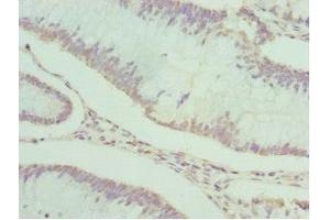 Immunohistochemistry of paraffin-embedded human colon cancer using ABIN7166867 at dilution of 1:100 (PDXK Antikörper  (AA 1-312))