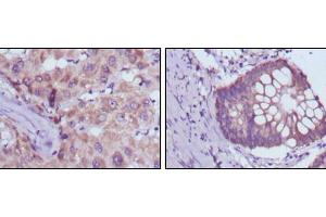 Immunohistochemical analysis of paraffin-embedded human liver cancer (left) and colorectal cancer tissues (right) using BDH1 mouse mAb with DAB staining. (BDH1 Antikörper)