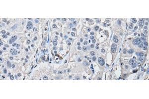Immunohistochemistry of paraffin-embedded Human esophagus cancer tissue using PRKAR2A Polyclonal Antibody at dilution of 1:50(x200) (PRKAR2A Antikörper)