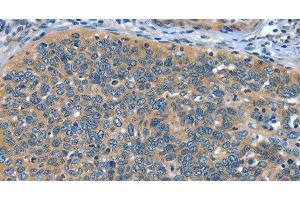Immunohistochemistry of paraffin-embedded Human cervical cancer tissue using DTX1 Polyclonal Antibody at dilution 1:30 (Deltex Homolog 1 Antikörper)