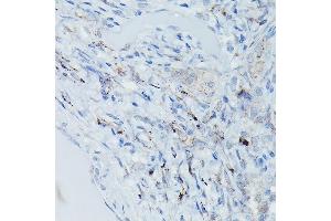 Immunohistochemistry of paraffin-embedded Human pulmonary tuberculosis using GSDME Rabbit pAb (ABIN6127757, ABIN6139554, ABIN6139555 and ABIN6223304) at dilution of 1:50 (40x lens). (Non-Syndromic Hearing Impairment Protein 5 (GSDME) (AA 1-260) Antikörper)
