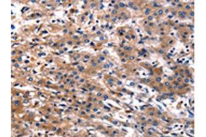 The image on the left is immunohistochemistry of paraffin-embedded Human liver cancer tissue using ABIN7128981(CNGA2 Antibody) at dilution 1/25, on the right is treated with fusion protein. (CNGA2 Antikörper)