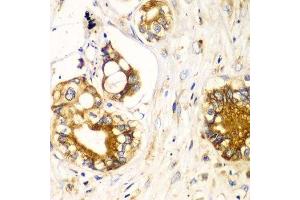 Immunohistochemistry of paraffin-embedded human liver cancer using RPN1 antibody. (RPN1 Antikörper  (AA 20-280))