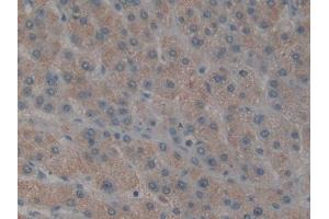 IHC-P analysis of Human Liver cancer Tissue, with DAB staining. (TAB1 Antikörper  (AA 189-439))