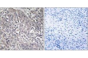 Immunohistochemistry analysis of paraffin-embedded human cervix carcinoma tissue, using InsP3R1 (Ab-1598/1588) Antibody. (ITPR1 Antikörper  (AA 1566-1615))